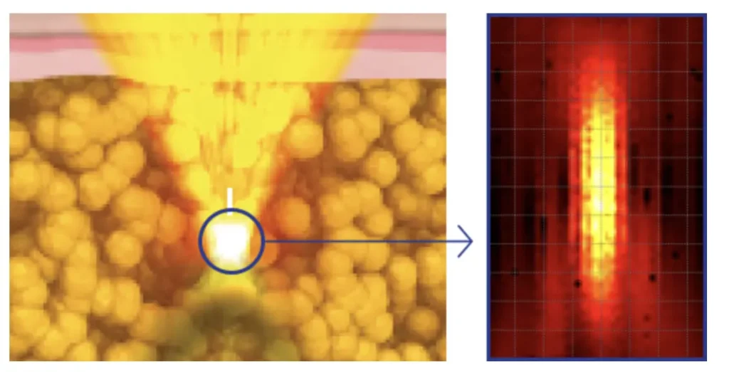 7d ultrasonic scalpel micro focus