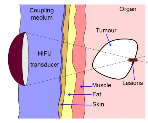 diagram showing liver lesioning using a hifu transducer