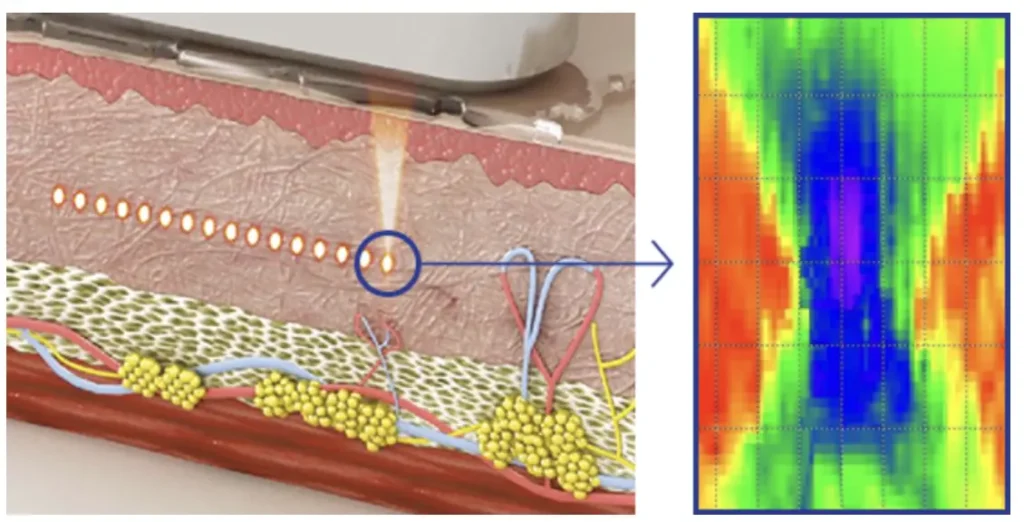 micro macro focused ultrasound technology diagram showing